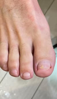 Gezonde nagel na de tiptoe-behandeling — 3 nagels behandeld · Resultaat in 8 maanden