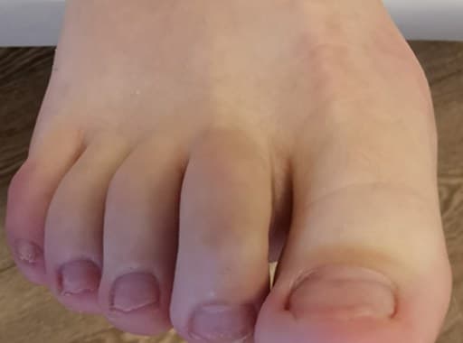 Na-foto van dezelfde voet met schoon uitgegroeide nagels na de tiptoe behandeling