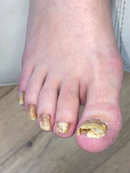Kalknagel voor de tiptoe-behandeling — 5 nagels behandeld · Resultaat in 12 maanden