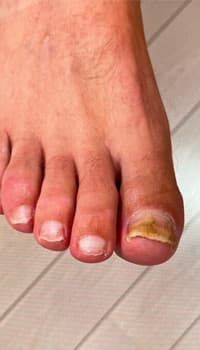 Kalknagel voor de tiptoe-behandeling — 3 nagels behandeld · Resultaat in 8 maanden