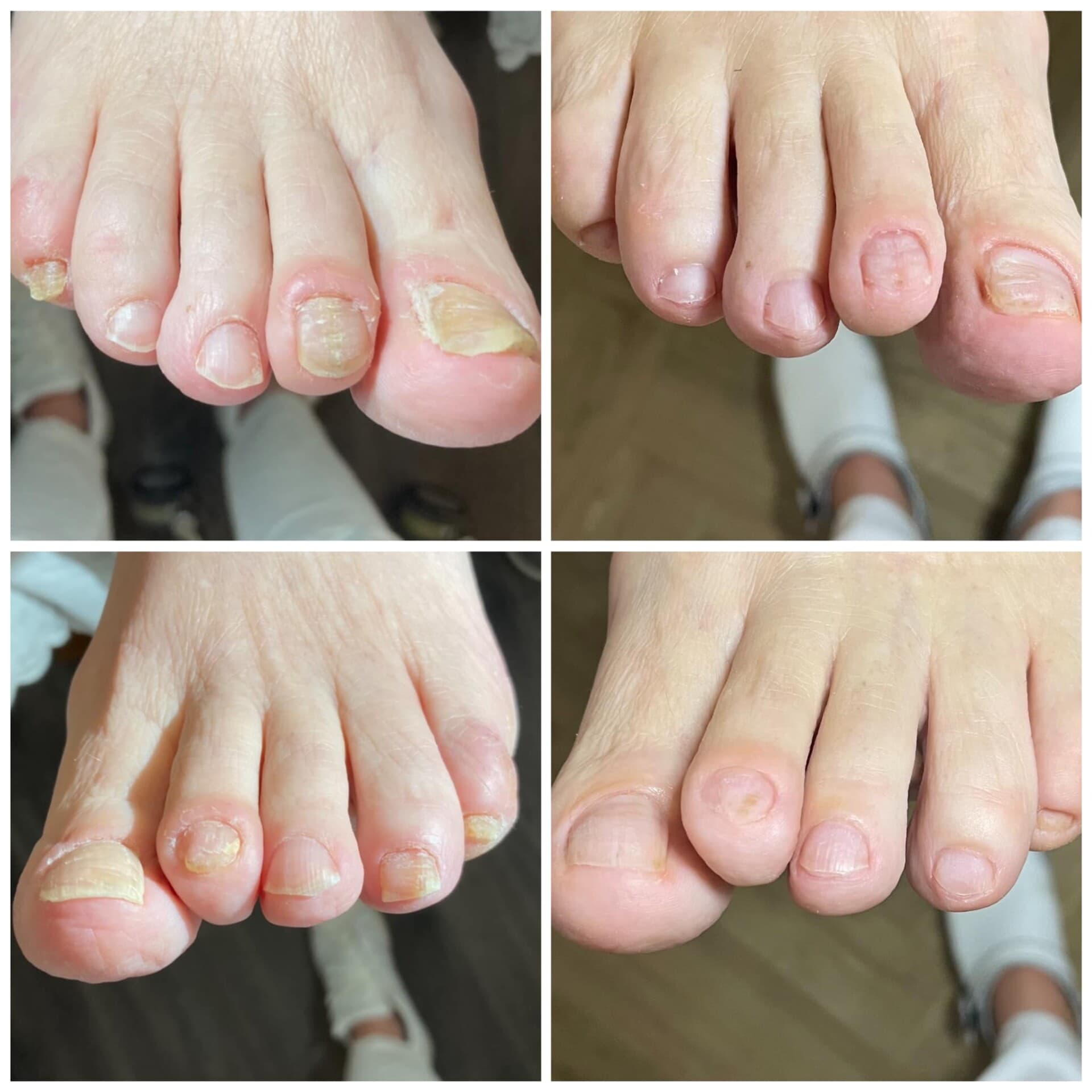 Voor- en na-foto van een kalknagelbehandeling bij tiptoe