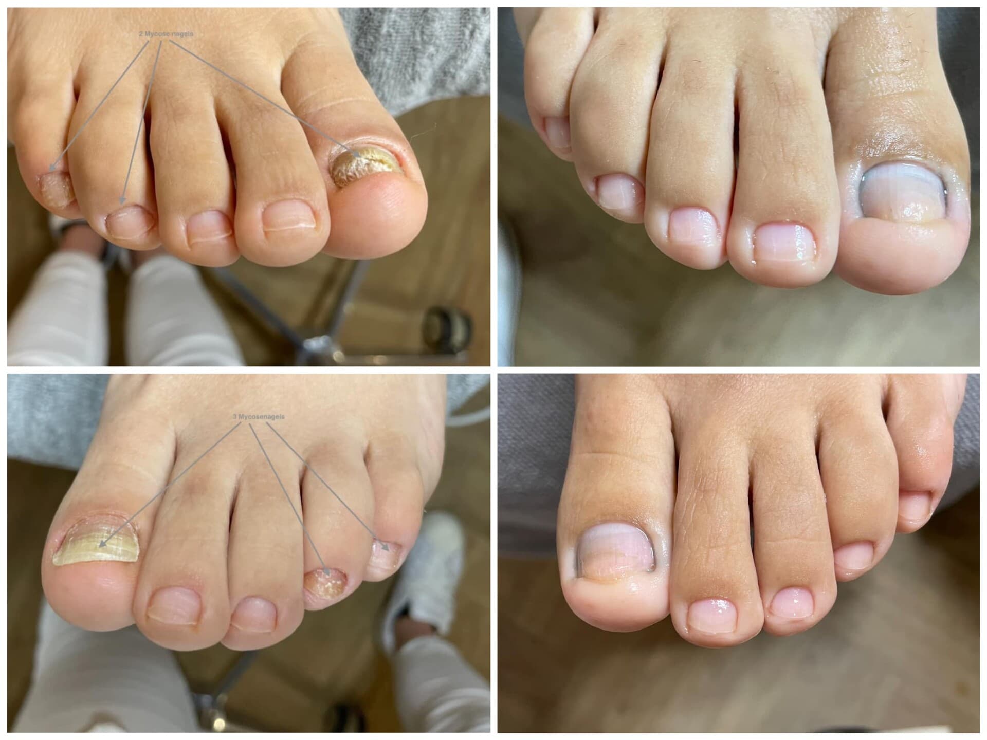 Voor- en na-foto van een kalknagelbehandeling bij tiptoe