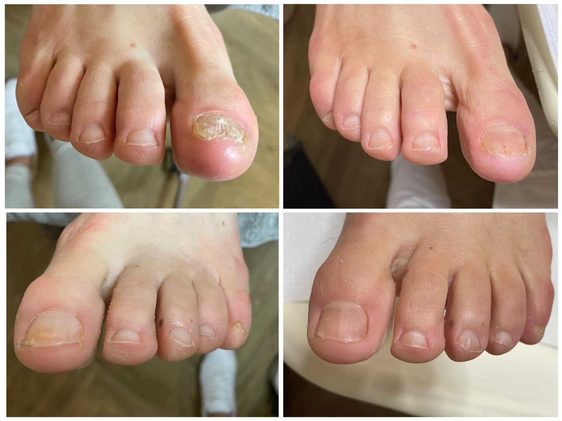 Voor- en na-foto van een kalknagelbehandeling bij tiptoe