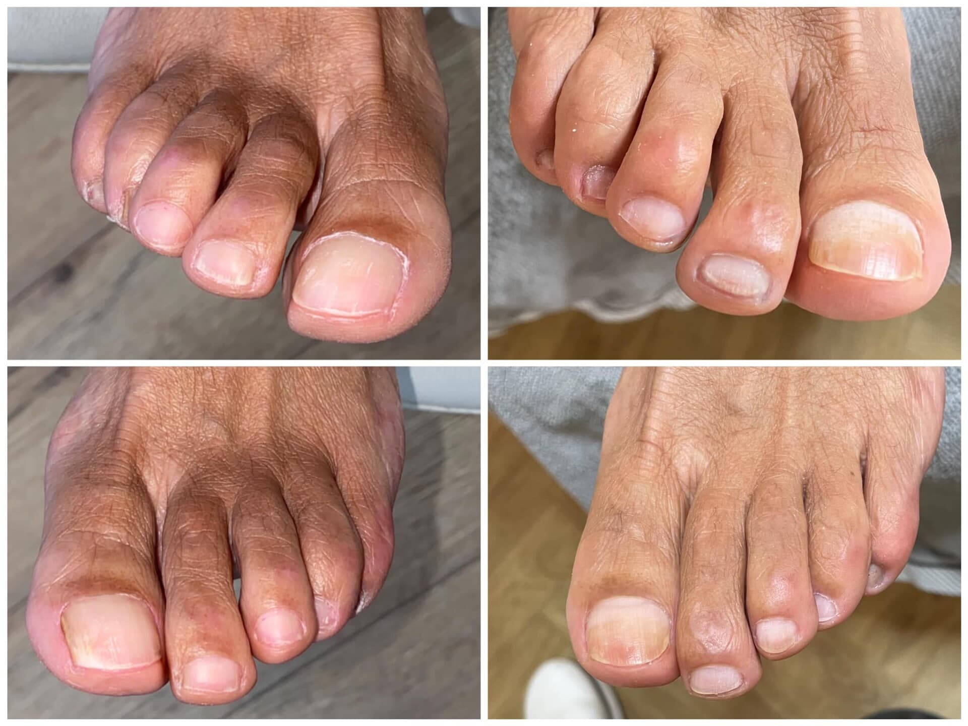 Voor- en na-foto van een kalknagelbehandeling bij tiptoe
