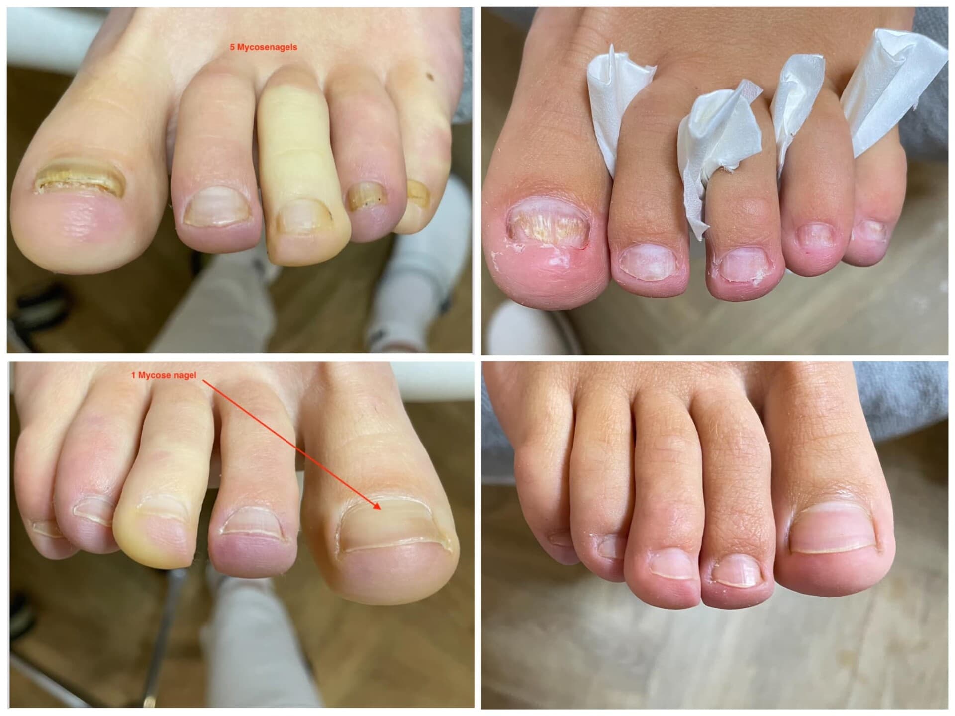 Voor- en na-foto van een kalknagelbehandeling bij tiptoe