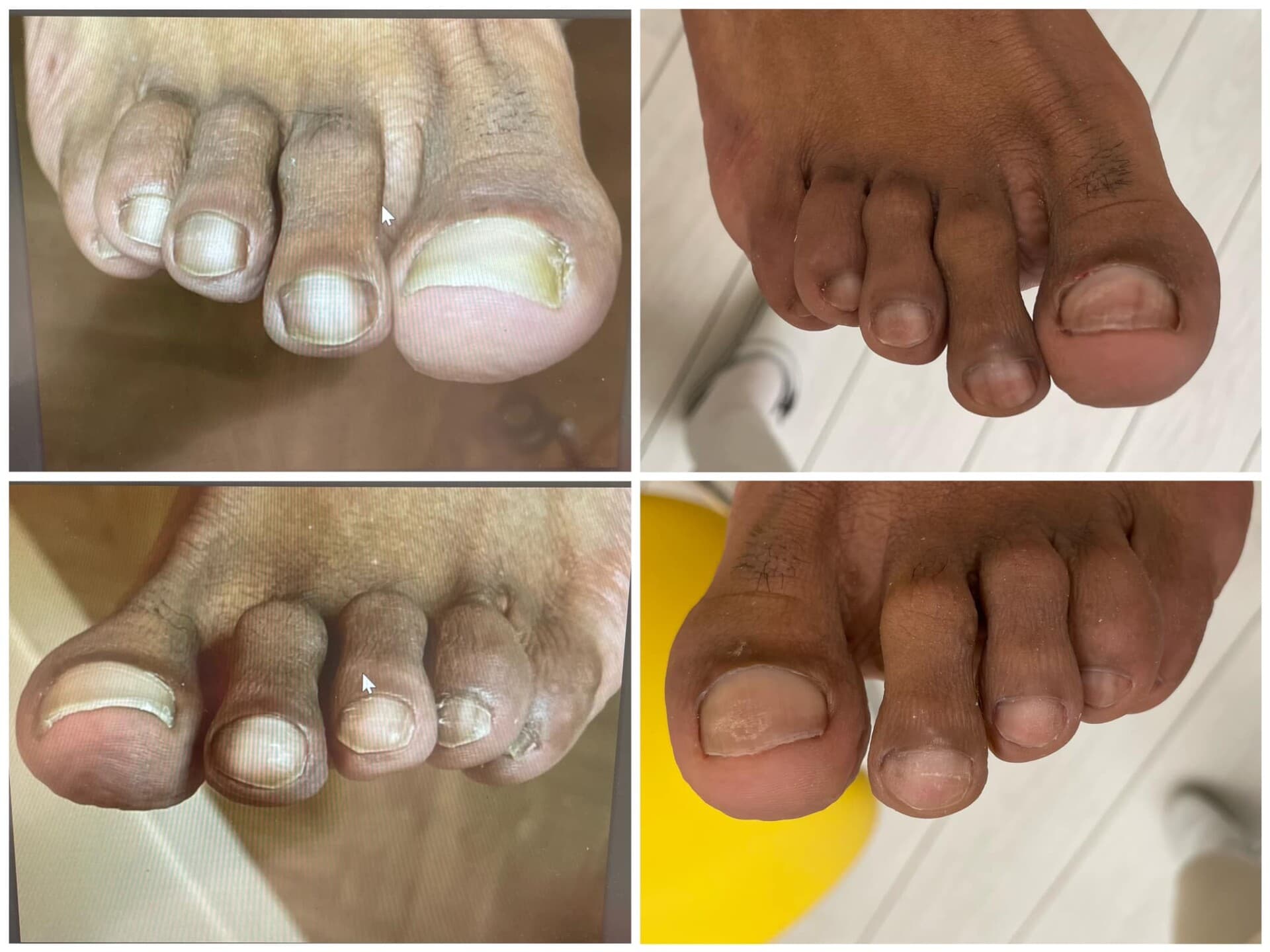 Voor- en na-foto van een kalknagelbehandeling bij tiptoe