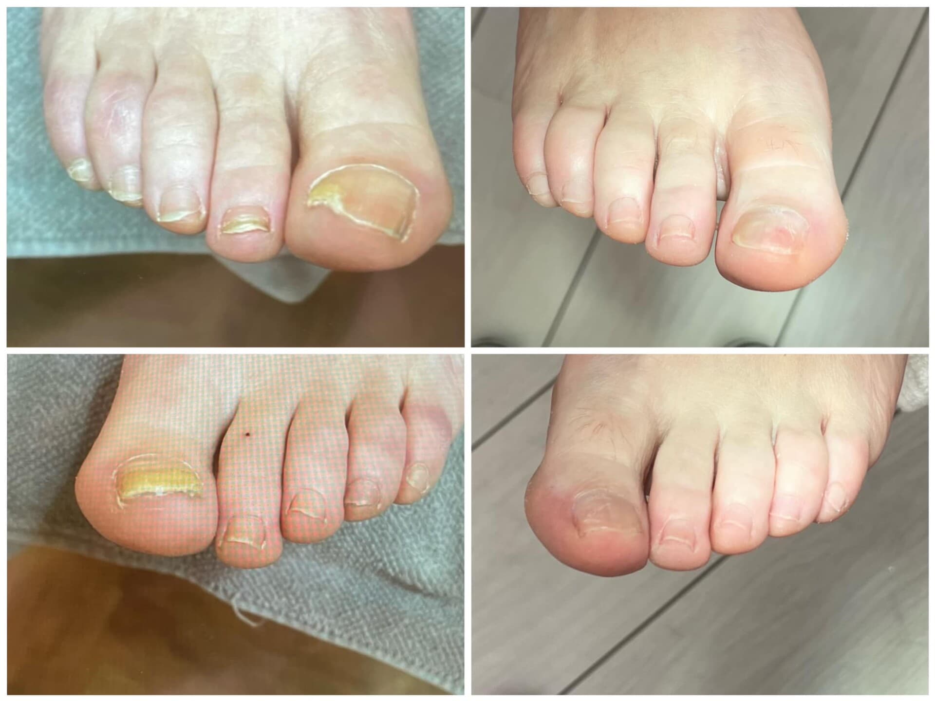 Voor- en na-foto van een kalknagelbehandeling bij tiptoe
