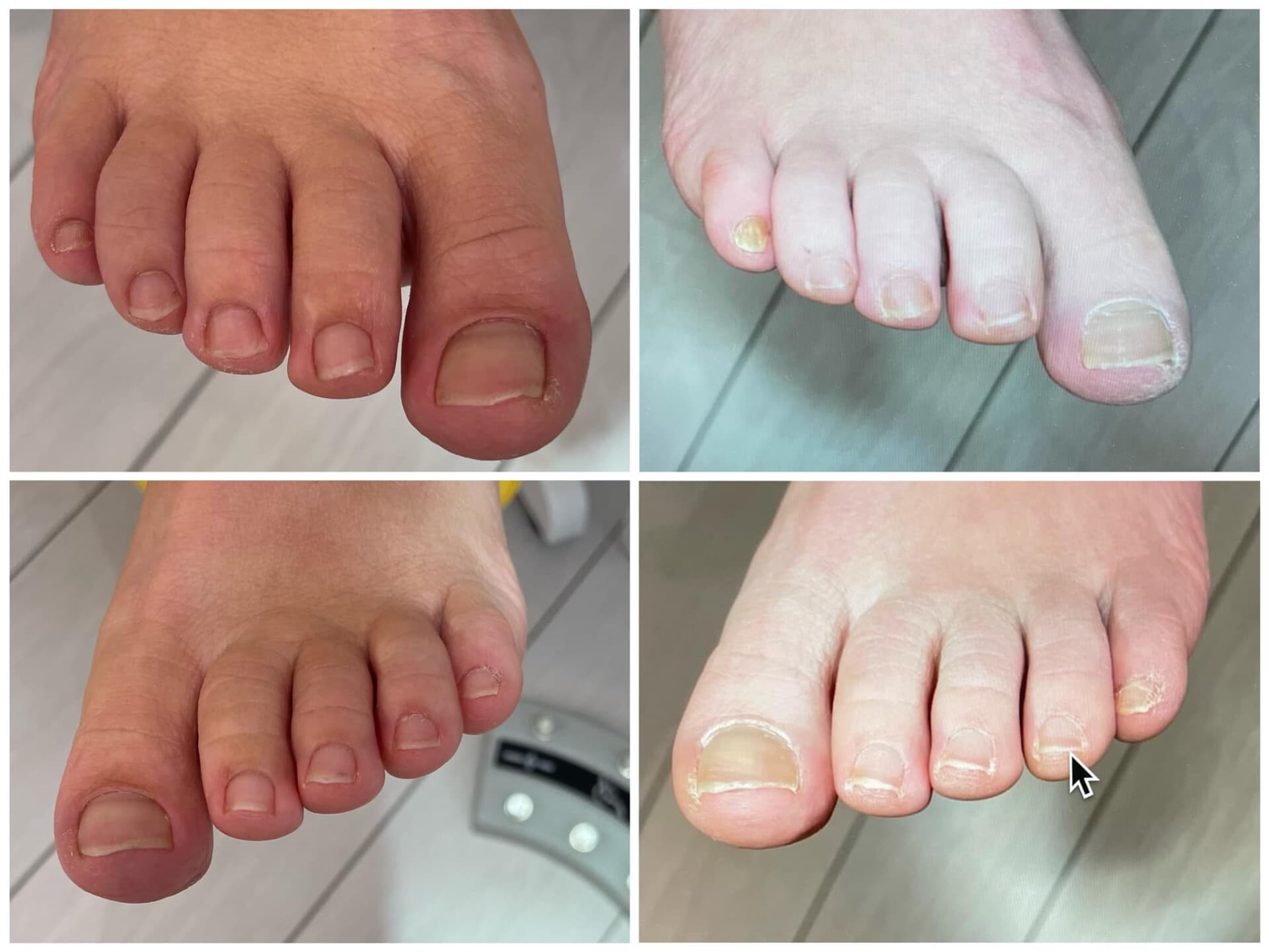Voor- en na-foto van een kalknagelbehandeling bij tiptoe