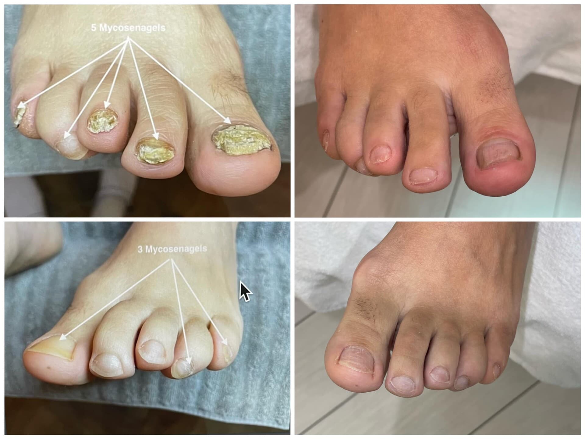 Voor- en na-foto van een kalknagelbehandeling bij tiptoe