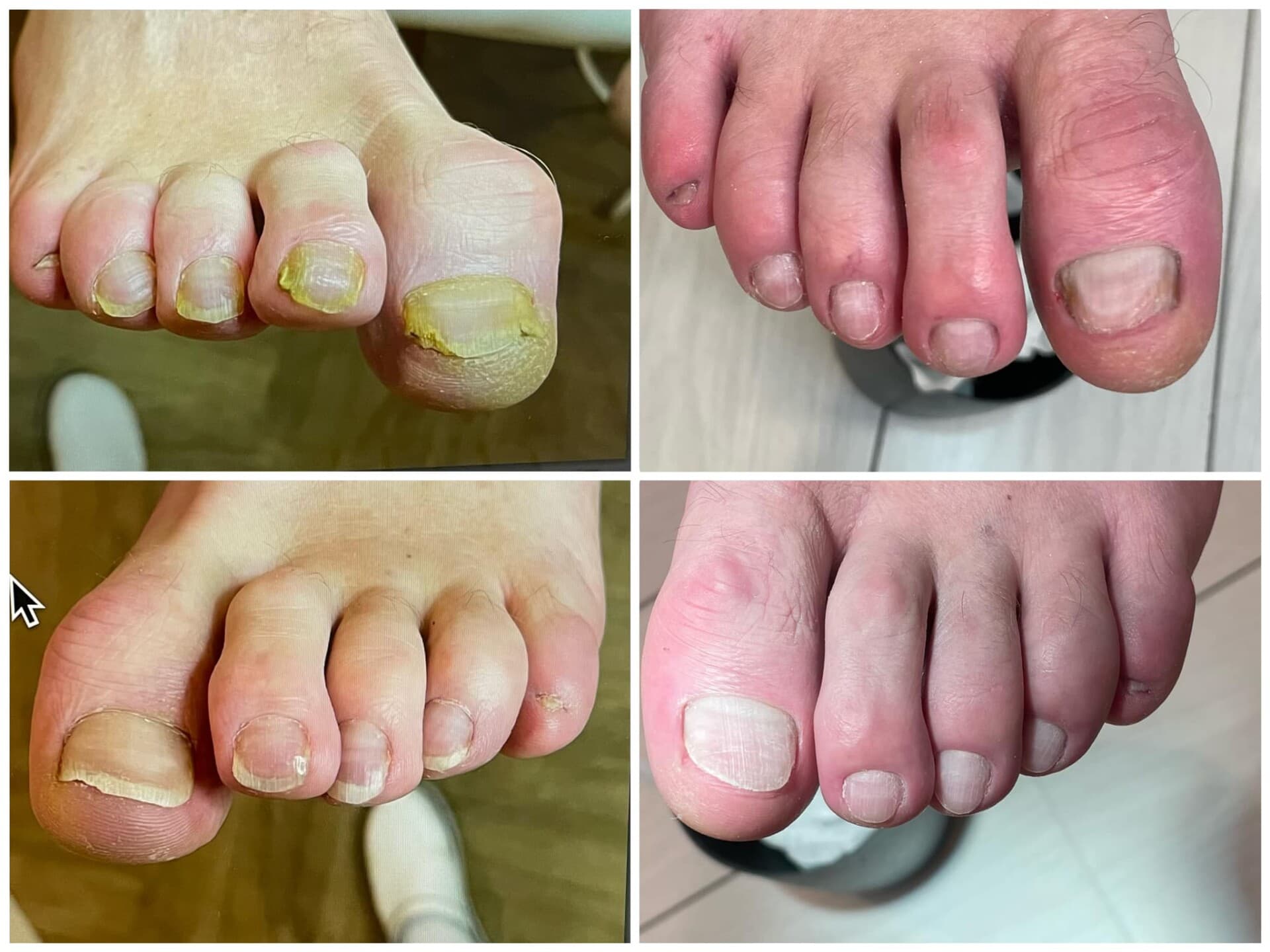 Voor- en na-foto van een kalknagelbehandeling bij tiptoe