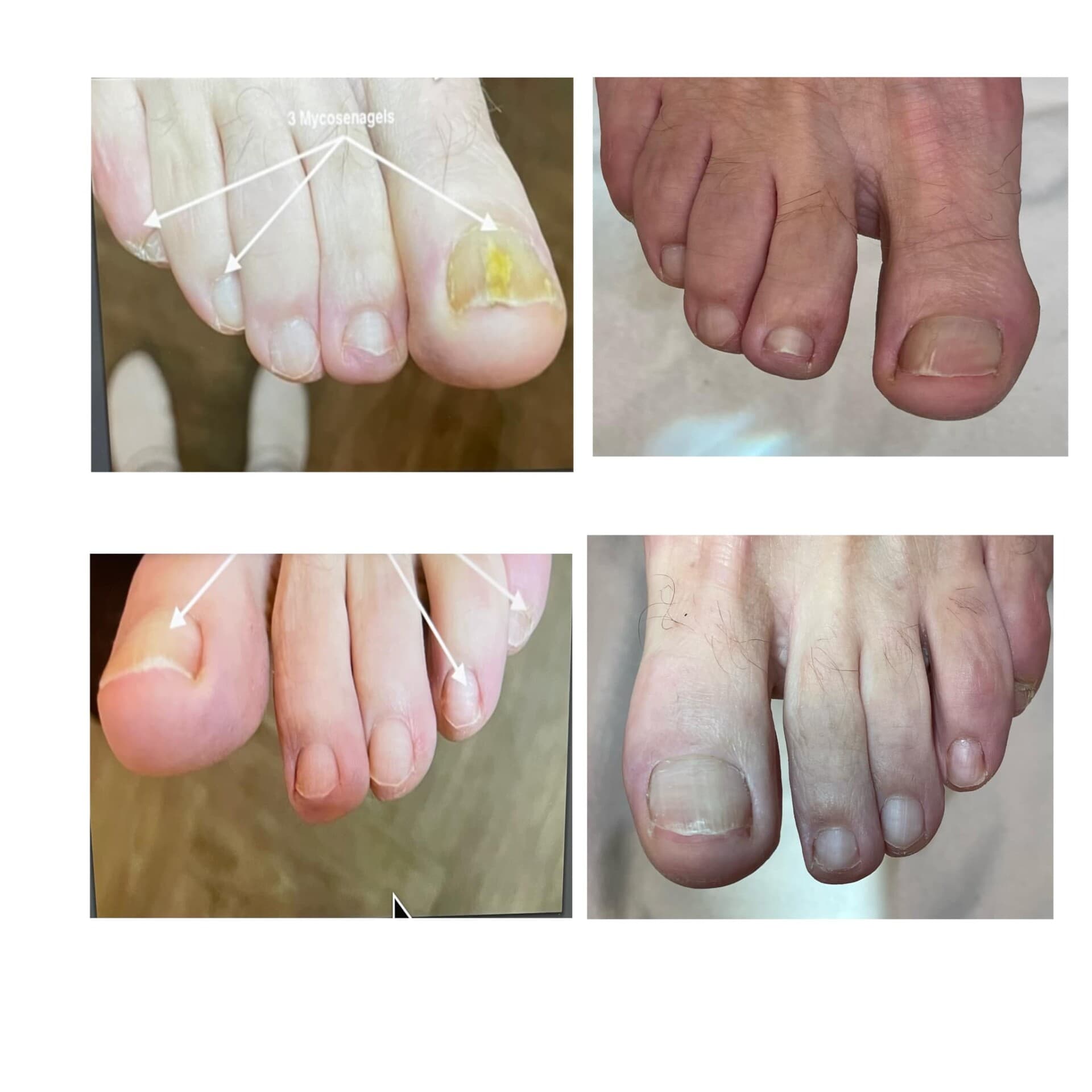 Voor- en na-foto van een kalknagelbehandeling bij tiptoe