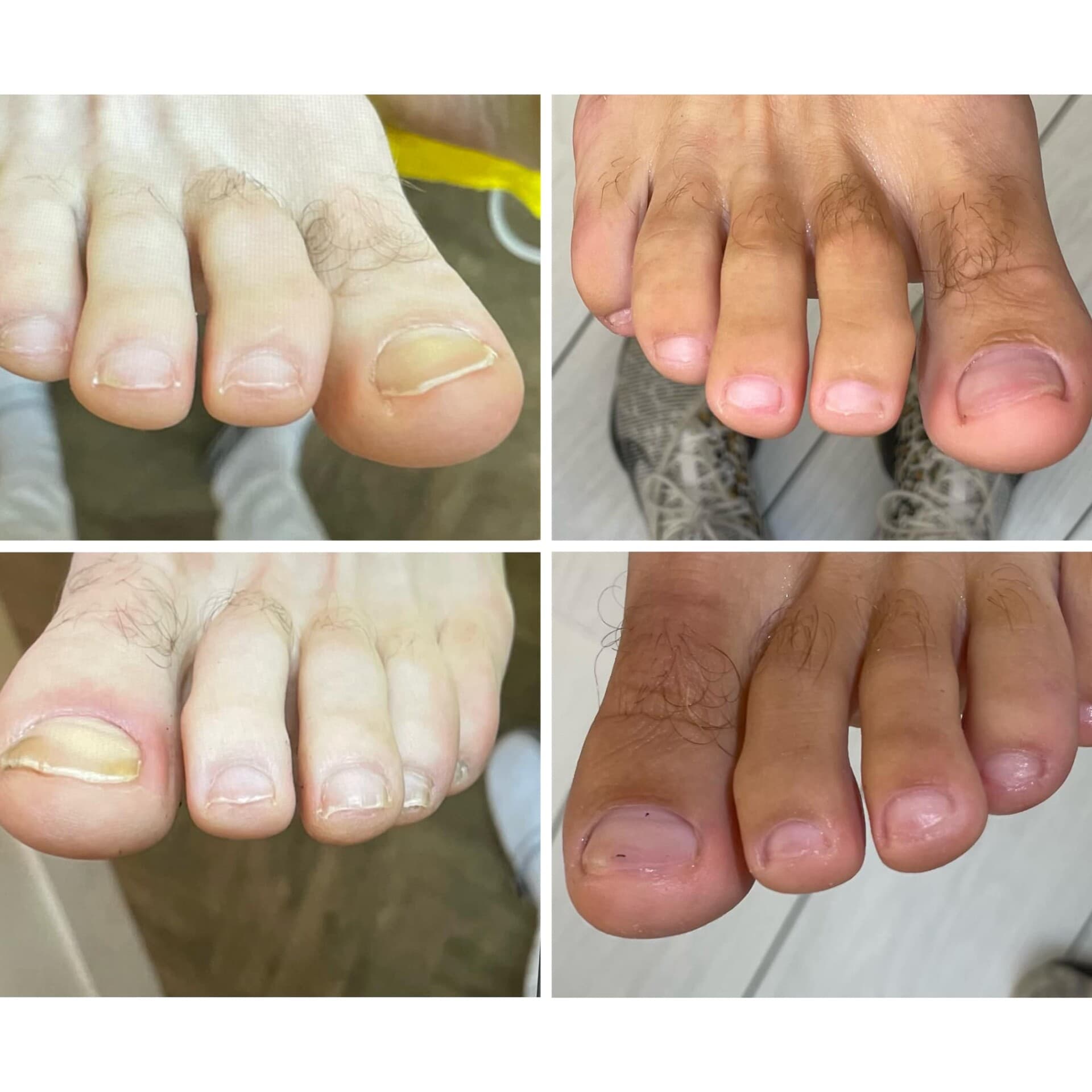 Voor- en na-foto van een kalknagelbehandeling bij tiptoe