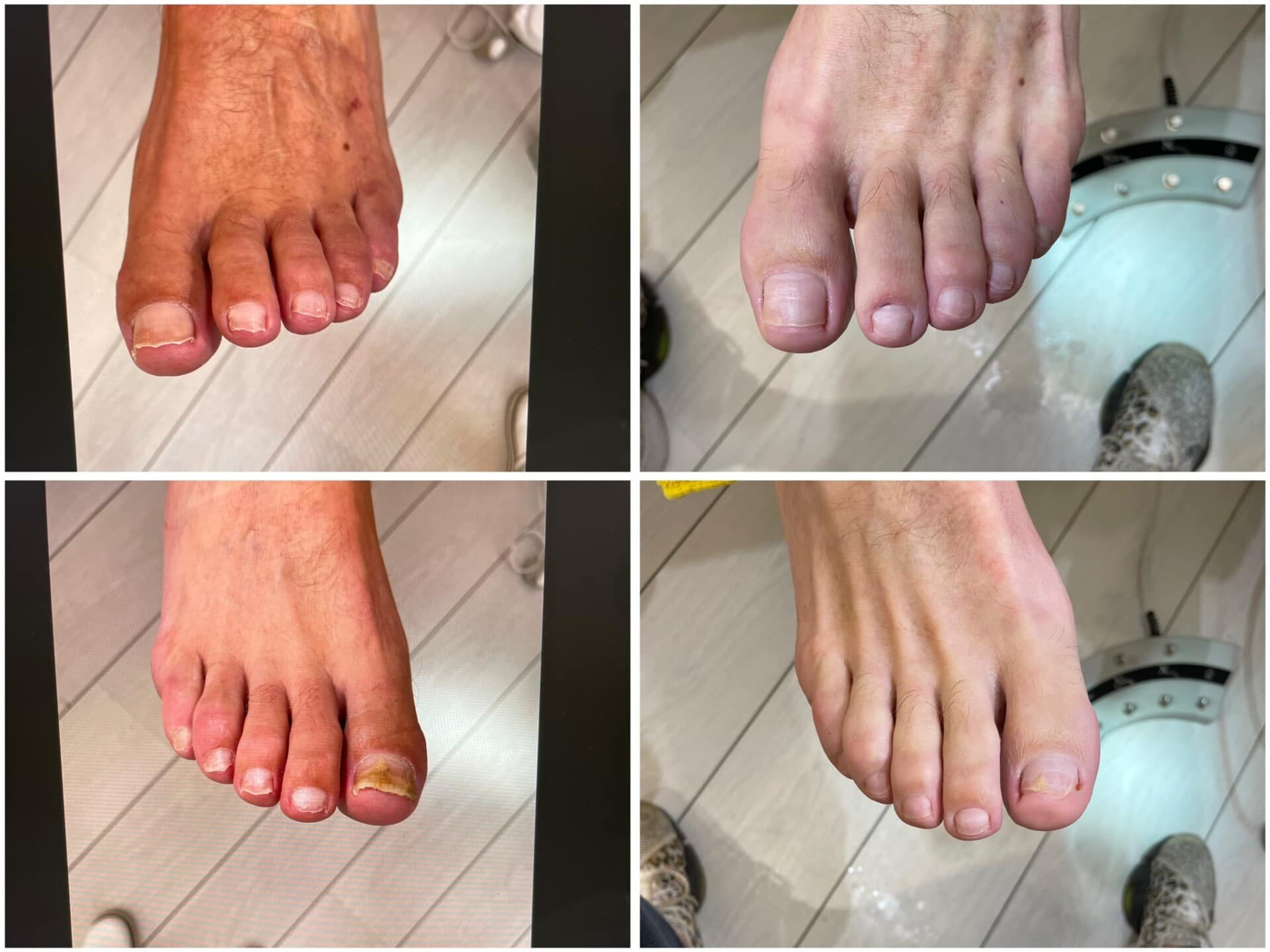 Voor- en na-foto van een kalknagelbehandeling bij tiptoe