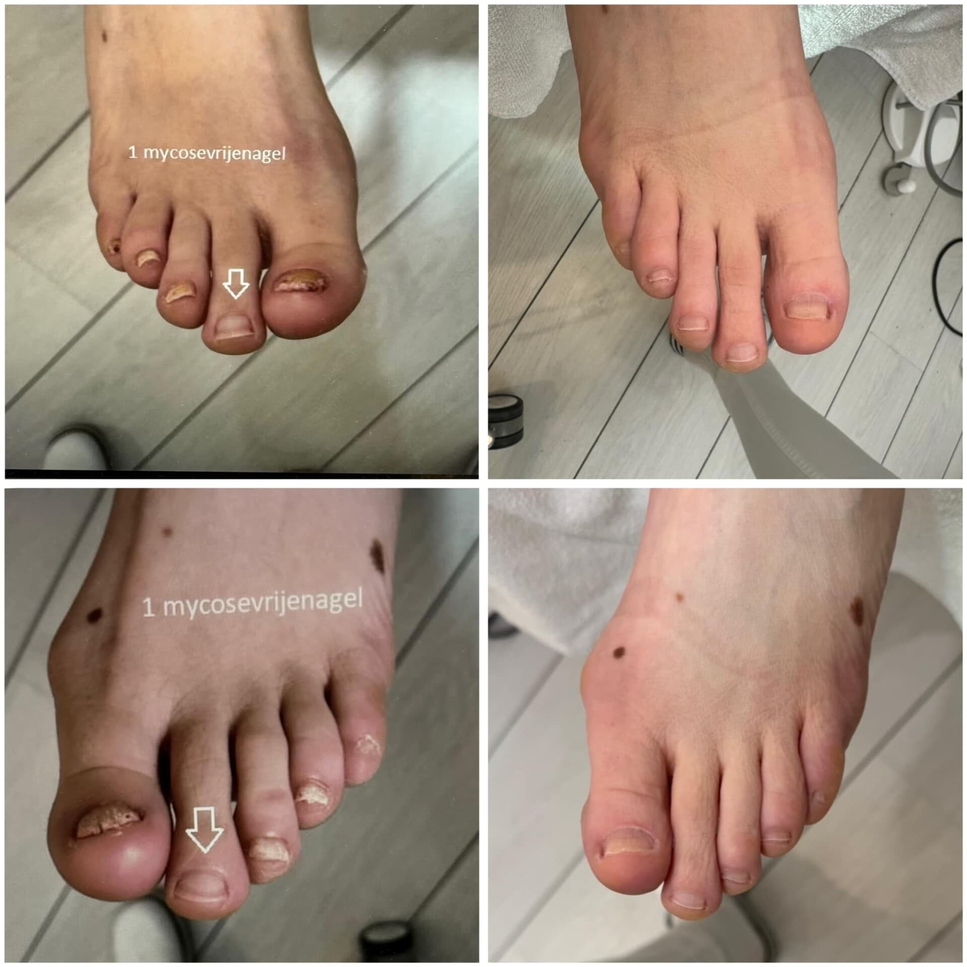 Voor- en na-foto van een kalknagelbehandeling bij tiptoe