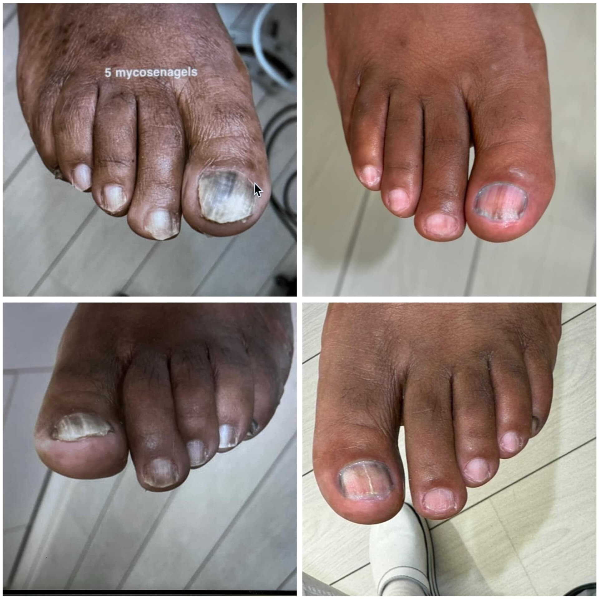 Voor- en na-foto van een kalknagelbehandeling bij tiptoe