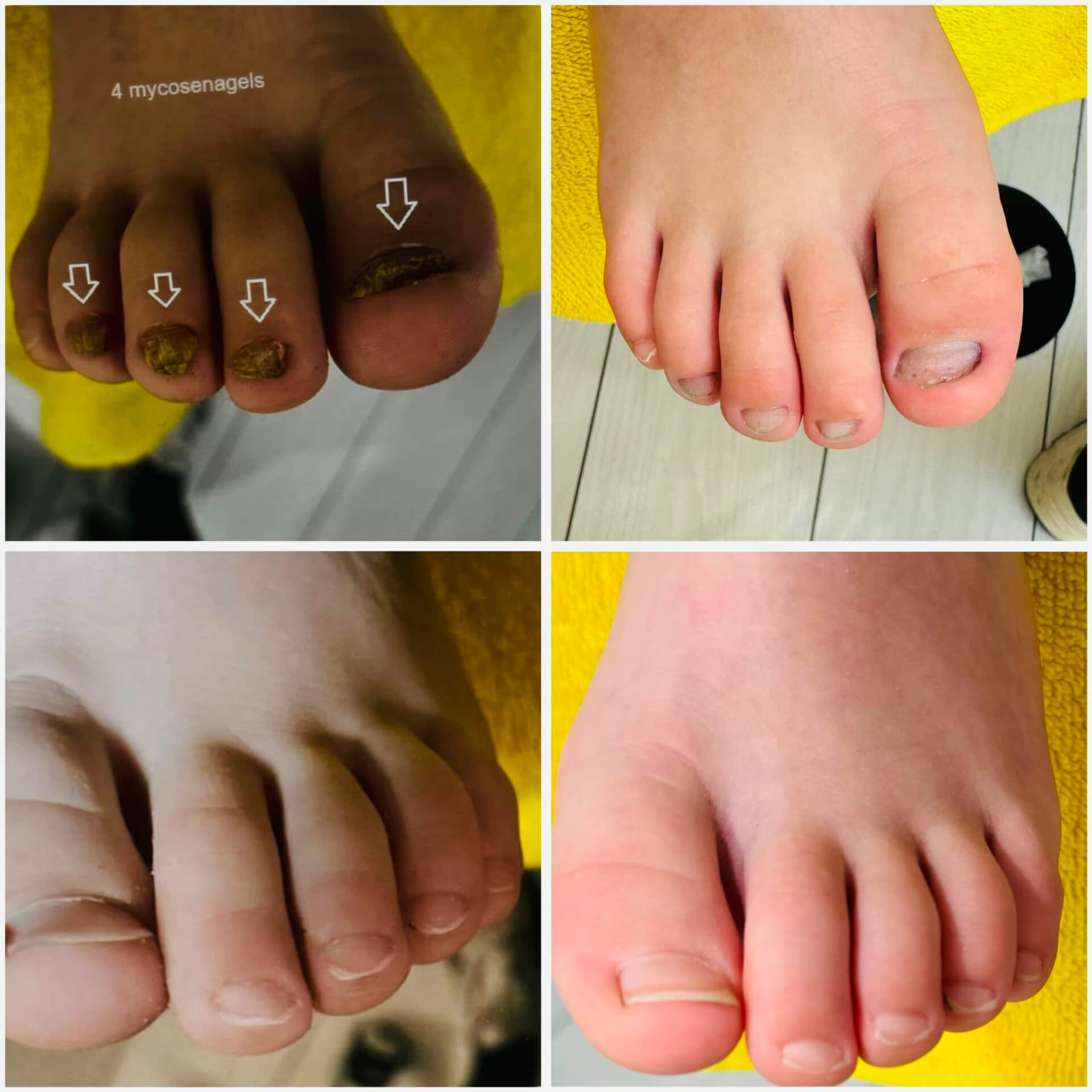 Voor- en na-foto van een kalknagelbehandeling bij tiptoe