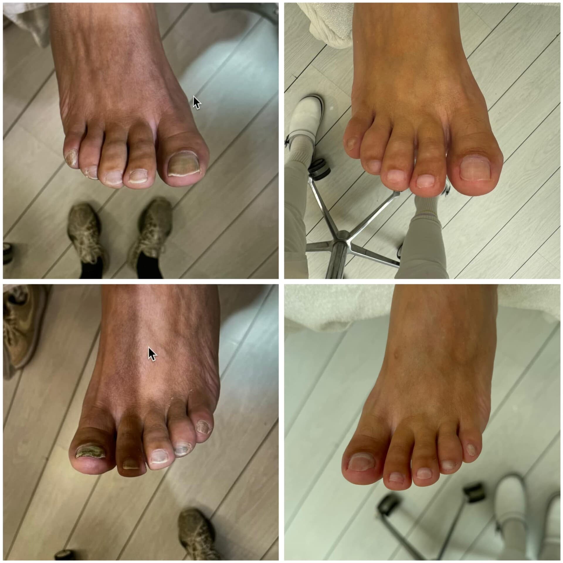 Voor- en na-foto van een kalknagelbehandeling bij tiptoe
