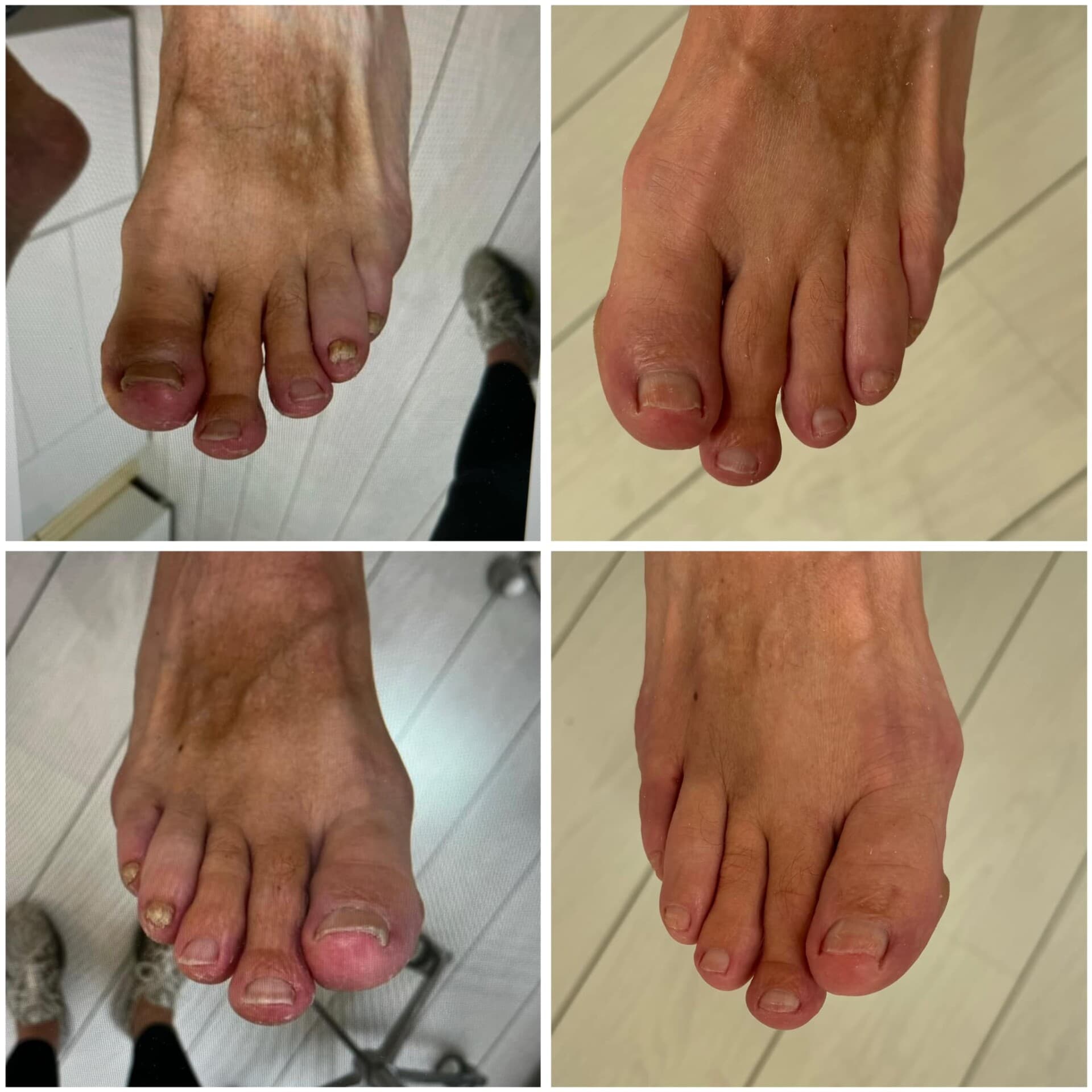 Voor- en na-foto van een kalknagelbehandeling bij tiptoe