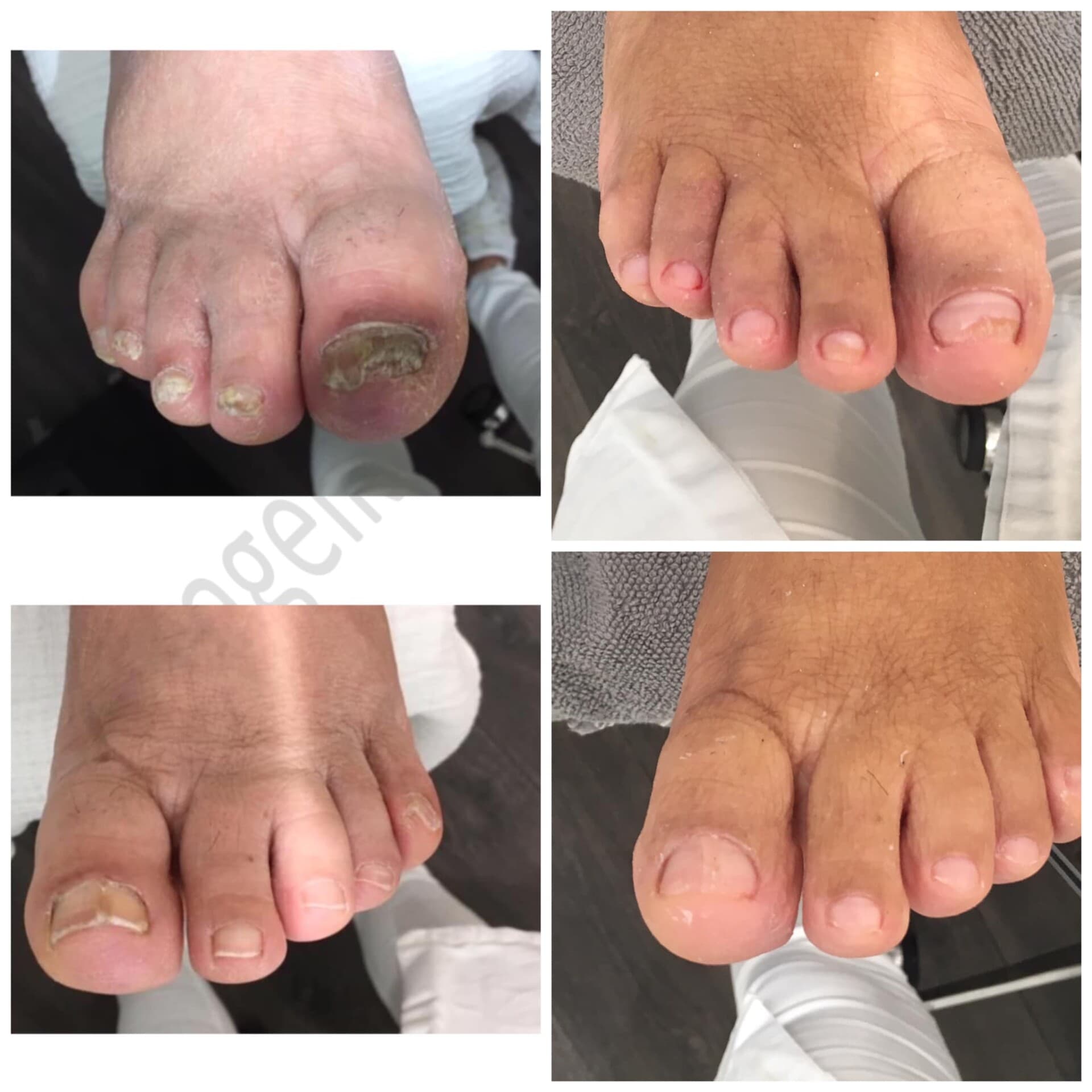 Voor- en na-foto van een kalknagelbehandeling bij tiptoe