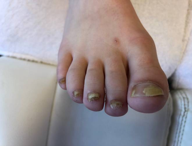 Voor-foto van de kalknagels bij een meisje van 11 jaar vóór de tiptoe behandeling