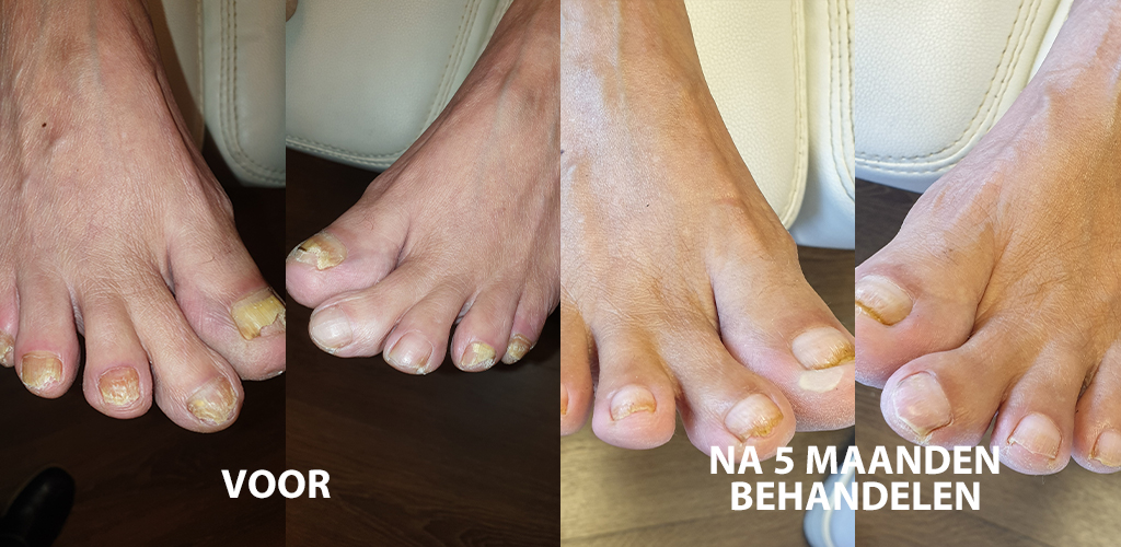 Voor- en na-foto van een schimmelnagelbehandeling na 5 maanden behandelen