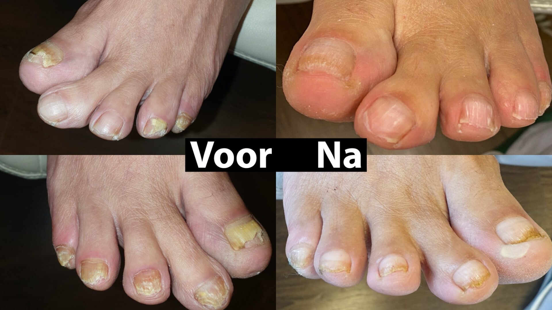 Voor- en na-foto van een schimmelnagelbehandeling na 3 maanden met PACT-therapie